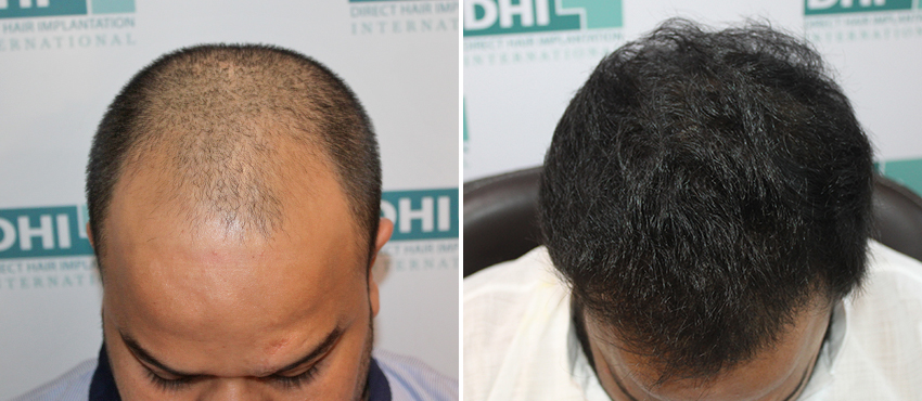 DHI before & after hair transplant results